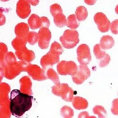 BLOOD | T-LGL白血病诊断、启动治疗及疗效评估国际共识标准